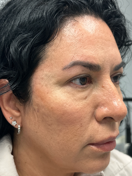 patient 91 before upper bleph with subbrow filler– right side.png
