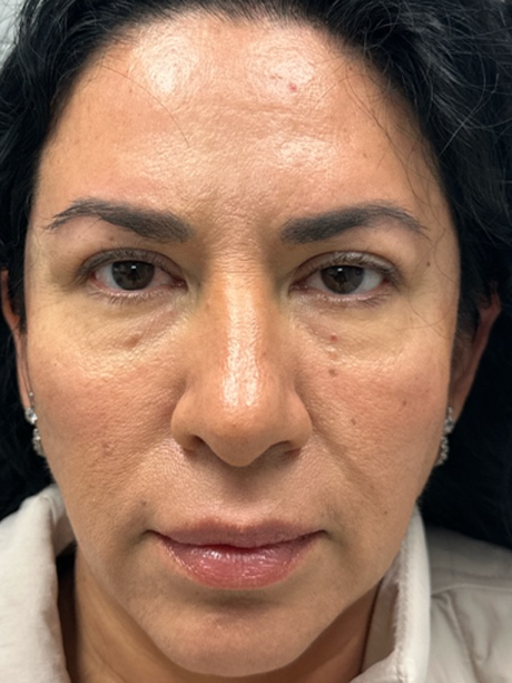 patient 91 before upper bleph with subbrow filler.png
