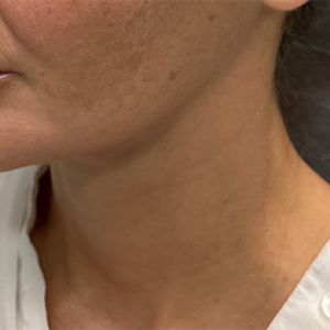 BY BONNIE patient 12 after botox for neck bands-side.png