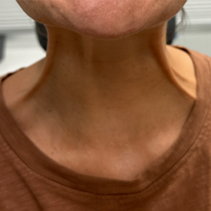 BY BONNIE patient 12 before botox for neck bands.png