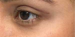 patient 16– 1 month after bleph with subbrow filler- side.png