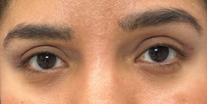 patient 16 –1 month after upper bleph with subbrow filler.png