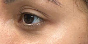 patient 16 before upper bleph with subbrow filler- side.png