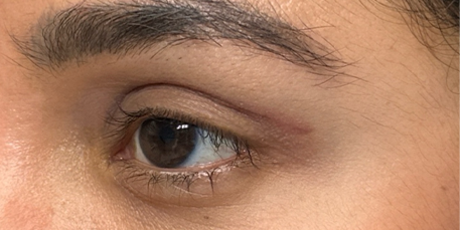 patient 18– 1 month after bleph with subbrow filler- side.png