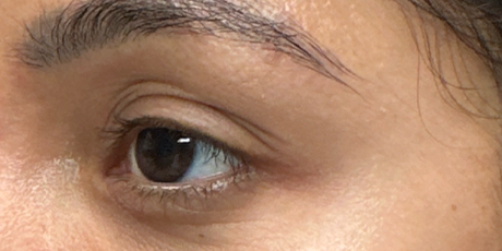 patient 18 before upper bleph with subbrow filler- side.png