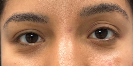 patient 18 before upper bleph with subbrow filler.png