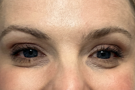 BY BONNIE- after botox front.png