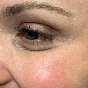 BY BONNIE- after botox left side.png