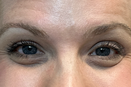 BY BONNIE- before botox front.png copy