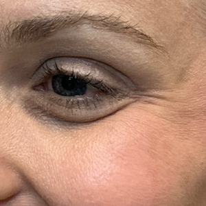 BY BONNIE- botox left side.png