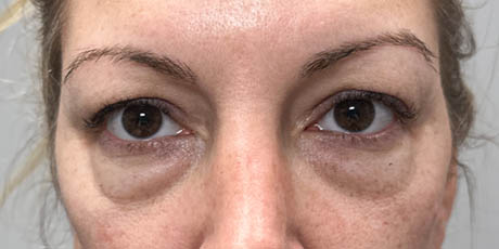 lb_0012_pt 12 before lower bleph with facial fat grafting- front.png