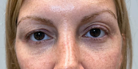 lb_0013_pt 12 after lower bleph with facial fat grafting- front.png