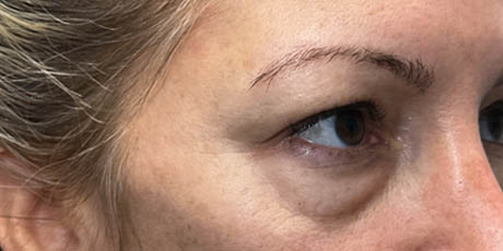 lb_0017_pt 12 before lower bleph with facial fat grafting- right side.png