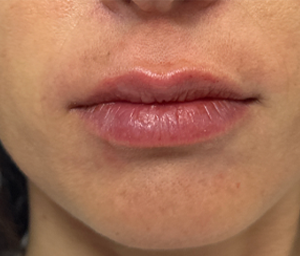 patient 13 after lip filler.png