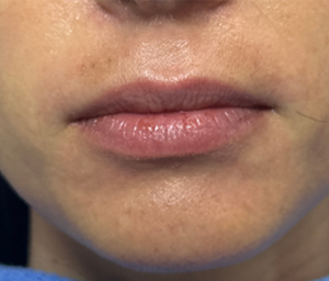 patient 13 before lip filler.png