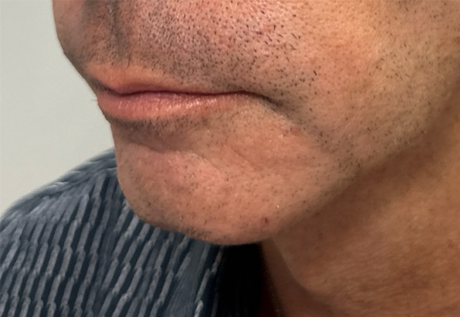 patient 15 after chin and jawline filler side 1.png