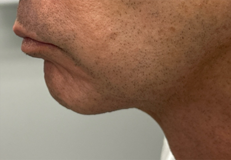 patient 15 before chin and jawline filler side 2.png