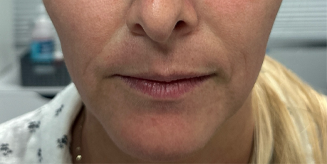 patient 8 after ultraclear with laser coring- front.png