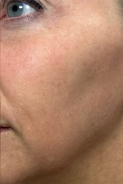 patient 8 after ultraclear with laser coring- left side.png