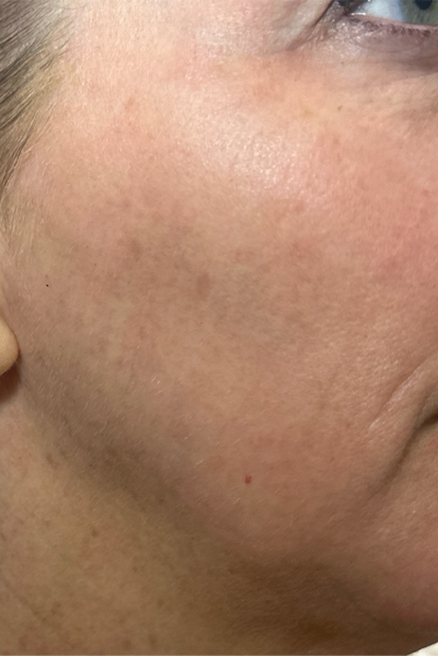 patient 8 after ultraclear with laser coring- right side.png