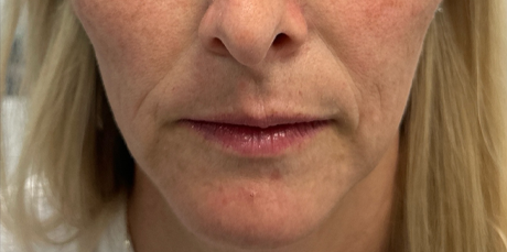 patient 8 before ultraclear with laser coring- front.png