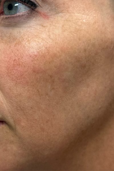 patient 8 before ultraclear with laser coring- left side.png