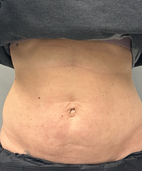 patient 9 after BY BONNIE 1 session of m8 to abdomen.png