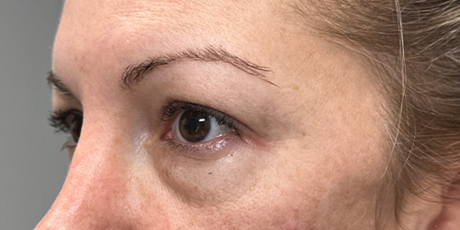 pt 12 before lower bleph with facial fat grafting- left side.png