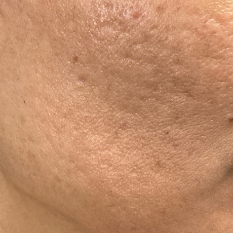 pt 9 before m8 and ultraclear for scars.png