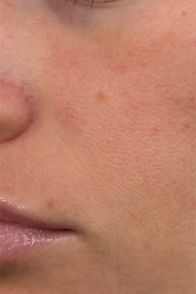 1_0000_BY BONNIE patient 10 before 3D MIRACL around the mouth