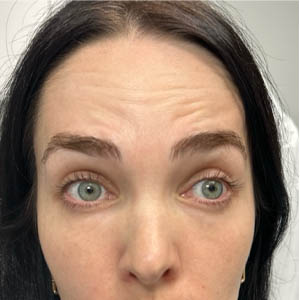 1_0000_BY BONNIE patient 13 before botox.png