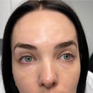 1_0001_BY BONNIE patient 13 after botox.png