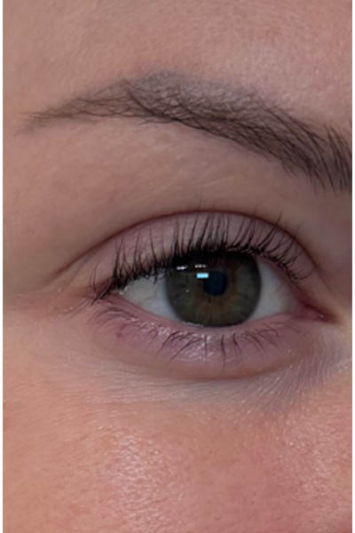 1_0002_BY BONNIE patient 10 after 3D MIRACL around the eyes