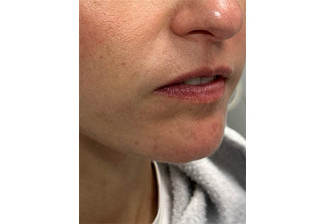 1_0002_patient 16 after filler chin and jaw and nasolabial folds- side