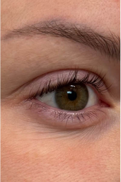 1_0003_BY BONNIE patient 10 before 3D MIRACL around the eyes