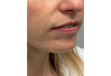 1_0003_patient 16 before filler chin and jaw and nasolabial folds- side