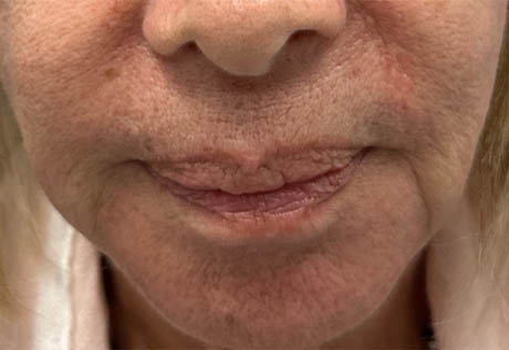 a_0000_patient 1 before filler corners of the mouth.png