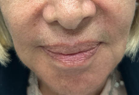 a_0001_patient 1 after filler corners of the mouth.png