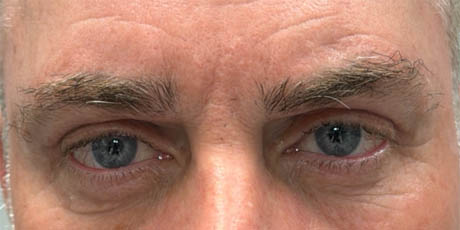 a_0001_patient 17 after upper bleph, direct brow lift and subbrow filler- front.png