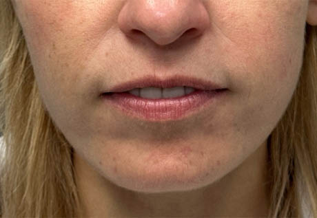 a_0002_patient 2 before filler chin and jaw and nasolabial folds- front.png