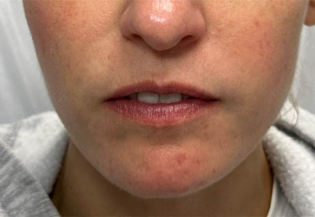 a_0003_patient 2 after filler chin and jaw and nasolabial folds- front.png