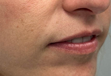 a_0004_patient 2 before filler chin and jaw and nasolabial folds- side.png