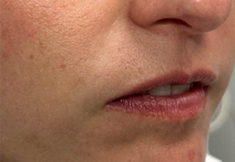 a_0005_patient 2 after filler chin and jaw and nasolabial folds- side.png