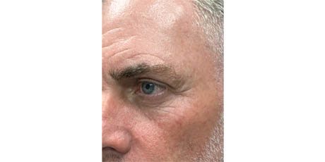 b_0002_patient 17 before upper bleph, direct brow lift and subbrow filler- left side.png