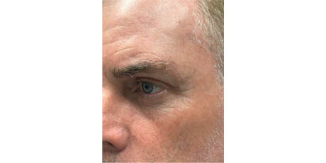 b_0003_patient 17 after upper bleph, direct brow lift and subbrow filler- left side.png