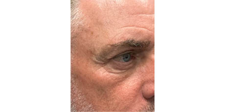 b_0004_patient 17 before upper bleph, direct brow lift and subbrow filler- right side.png