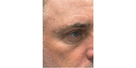 b_0005_patient 17 after upper bleph, direct brow lift and subbrow filler- right side.png