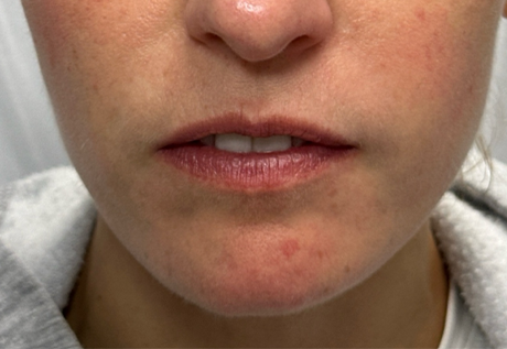 patient 16 after filler chin and jaw and nasolabial folds- front