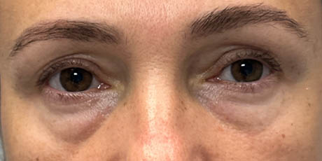 1_0000_patient 13 before lower bleph with facial fat grafting.png