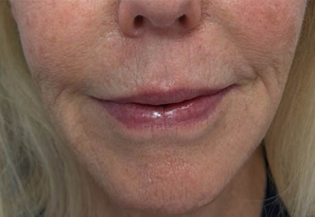 1_0000_patient 3 after filler corners of mouth.png